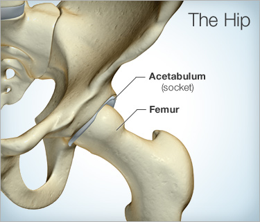 hip replacement diagram