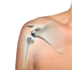 reverse- shoulder replacement
