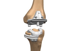 Custom-Fit Knee Replacement