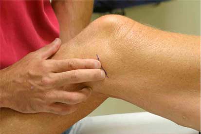 ¿Qué hace que nuestra clínica sea tan efectiva en el tratamiento de lesiones de rodilla?