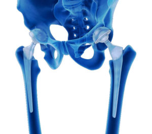 anterior hip replacement All-Pro Orthopedics