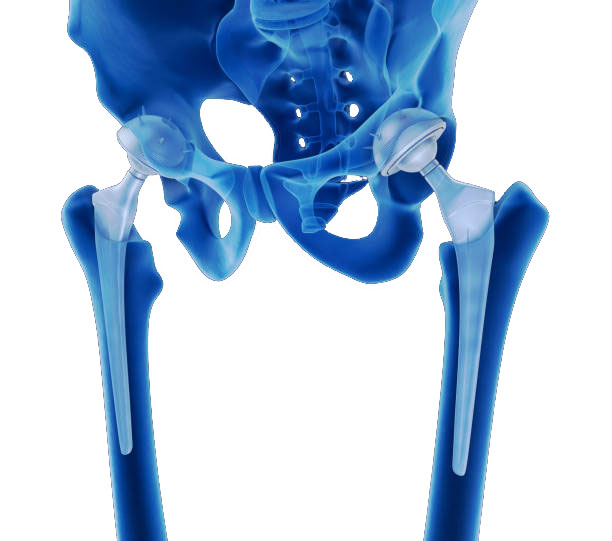 What is the Newest Hip Replacement Procedure?