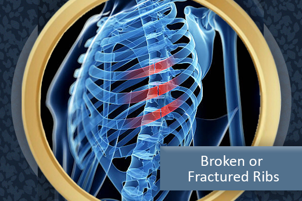 Broken or Fractured Ribs
