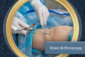 Knee Arthroscopy Pembroke Pines FL