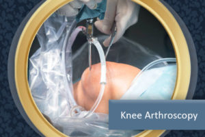 Knee Arthroscopy Pembroke Pines FL